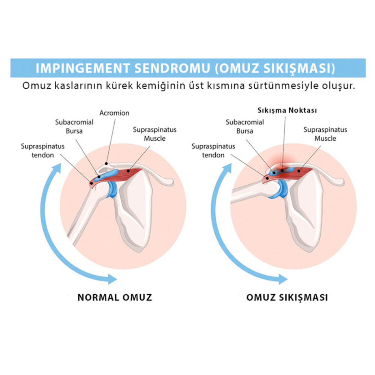 İmpingement sendromu ve Atlas Terapi / Manuel Terapi İlişkisi