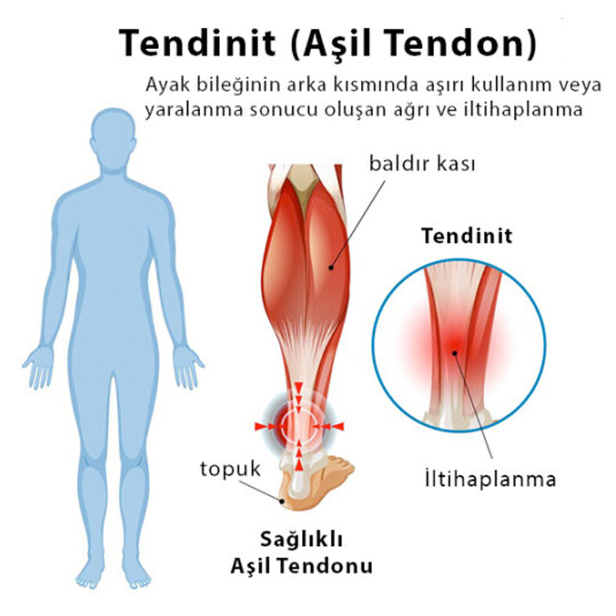 Tendinit: Mekanizması, Manuel Terapi ve Atlas Terapi ile İlişkisi